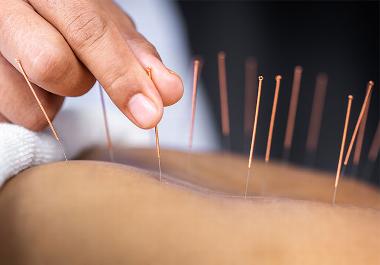 Acupuncture on clients back