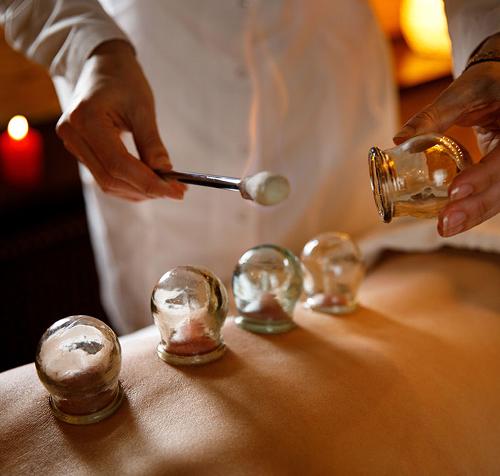 Cupping massage at our clinic in Canary Wharf